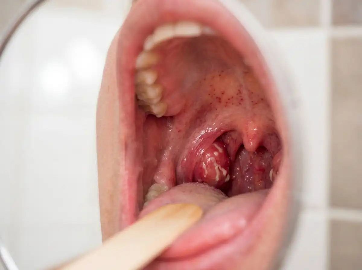 Signs and Symptoms of Strep Throat in Adults